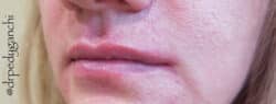 Lip Augmentation