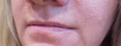 Lip Augmentation