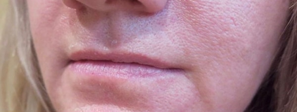 Lip Augmentation