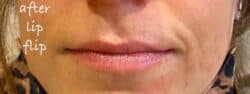 Lip Augmentation