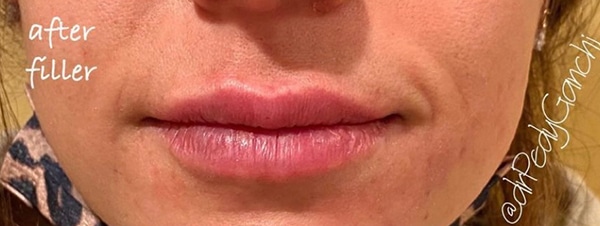 Lip Augmentation