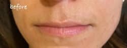 Lip Augmentation