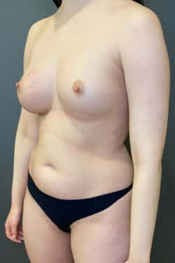 Breast Fat Grafting