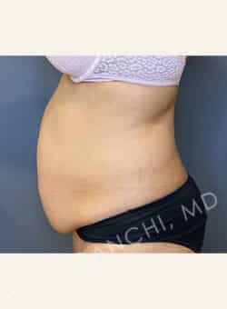 Tummy Tuck