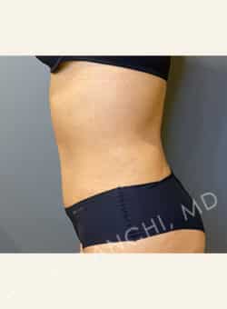 Tummy Tuck