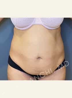 Tummy Tuck