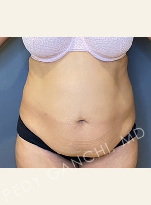 Tummy Tuck