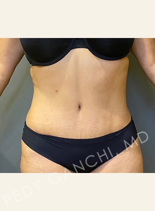 Tummy Tuck