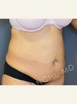 Tummy Tuck