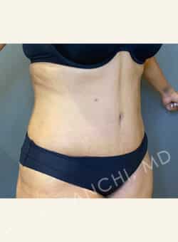 Tummy Tuck