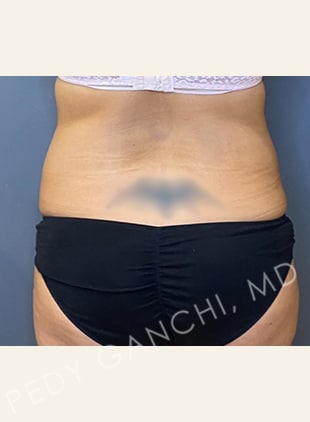 Tummy Tuck