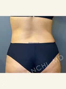 Tummy Tuck