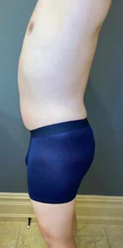 Liposuction