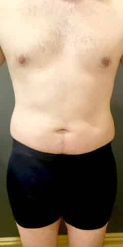 Liposuction