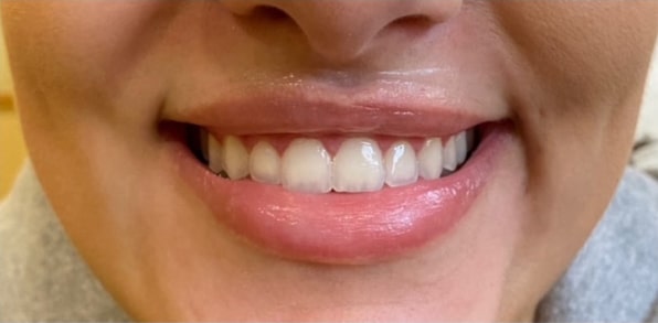 Lip Augmentation