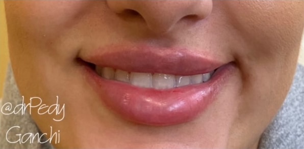 Lip Augmentation