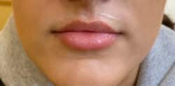 Lip Augmentation