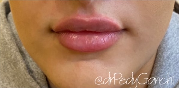 Lip Augmentation