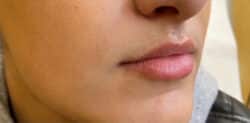 Lip Augmentation