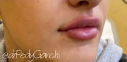 Lip Augmentation