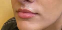 Lip Augmentation