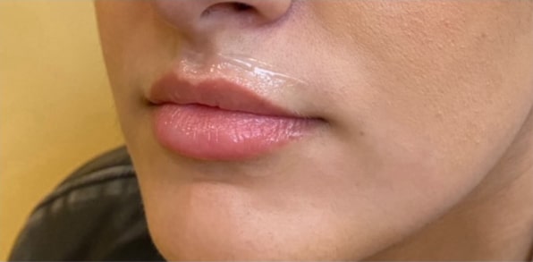 Lip Augmentation