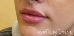 Lip Augmentation