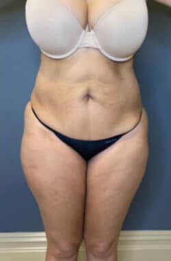 Tummy Tuck