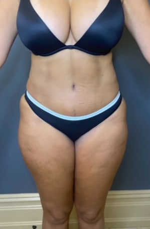 Tummy Tuck