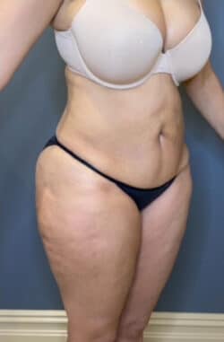 Tummy Tuck