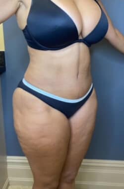 Tummy Tuck