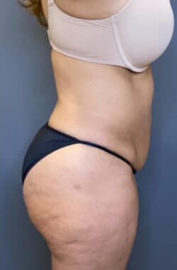 Tummy Tuck