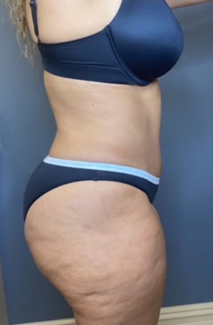 Tummy Tuck