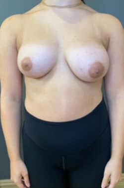 Breast Reduction (female)