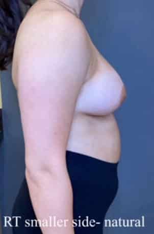 Breast Reduction (female)