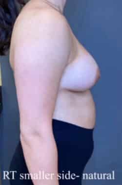 Breast Asymmetry