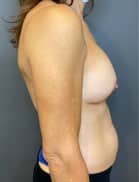 Breast Implant Revision (Explant)