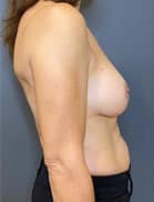 Breast Implant Revision (Explant)