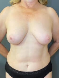 Breast Lift