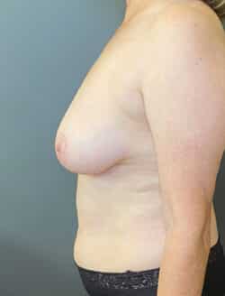 Breast Lift