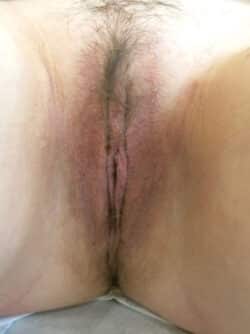 Labiaplasty