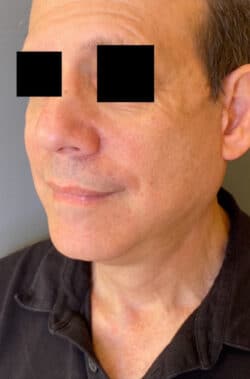 Face / Neck Lift