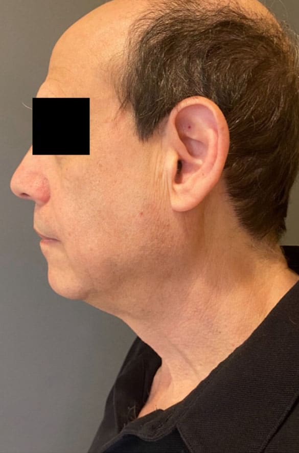 Face / Neck Lift