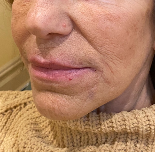 Fillers