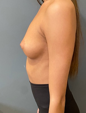 Breast Augmentation (Implants)