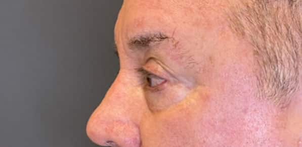 Eyelid Tuck