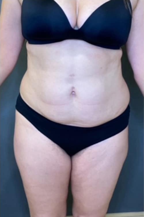 Tummy Tuck