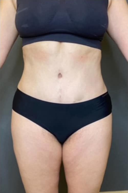 Tummy Tuck