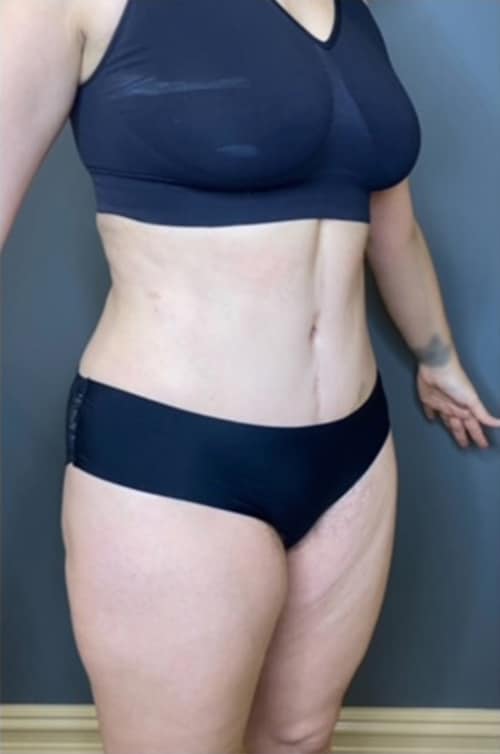 Tummy Tuck