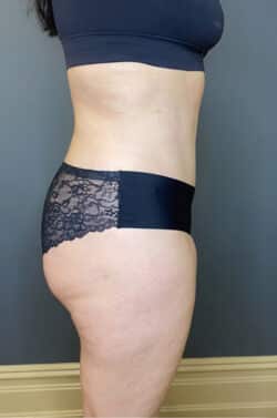 Tummy Tuck